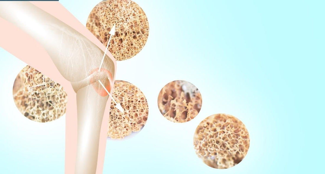 Breaking The Silence: Demystifying Osteoporosis And Bone Health